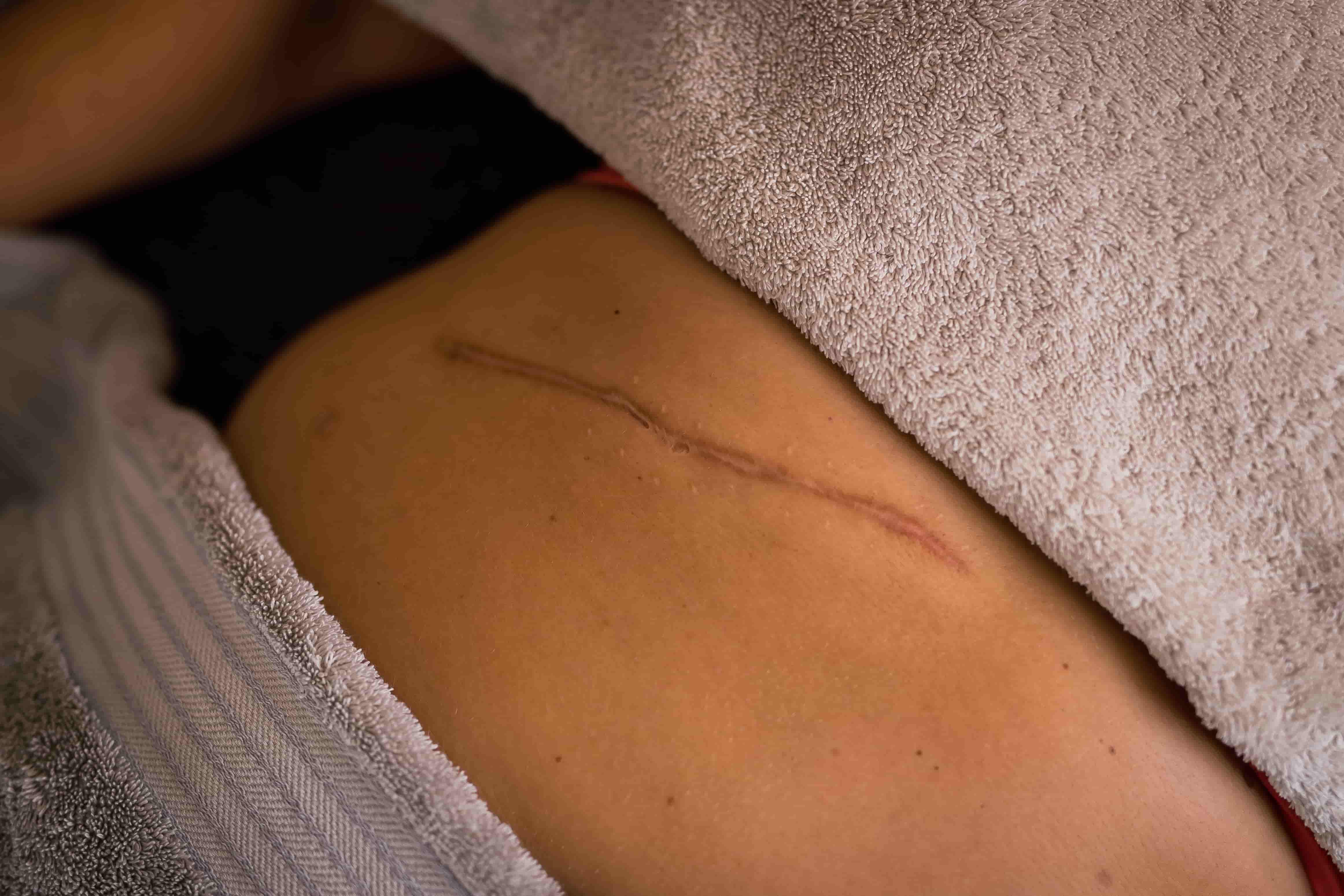 a scar across a persons abdomen